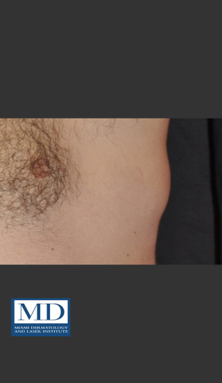 After Photo for  Body Contouring Treatment 144 - Jill S. Waibel, MD - Prejuvenation