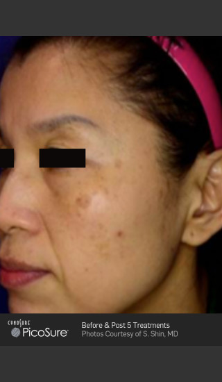 Before Photo for Wrinkle Reduction with PicoSure -  - Prejuvenation