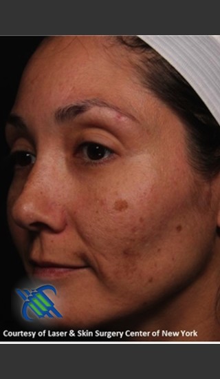 Before Photo for Pigment Facial Skin Rejuvenation - Roy G. Geronemus, M.D. - Prejuvenation