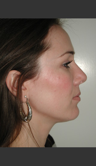 After Photo for Rhinoplasty Surgery  - James Newman - Prejuvenation