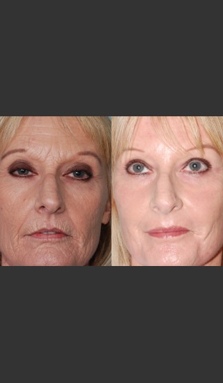 Before Photo for Laser resurfacing and laser eyelid surgery performed on same day. - Mark B. Taylor, M.D. - Prejuvenation