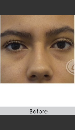 Before Photo for Undereye Filler - Annie Chiu, MD - Prejuvenation