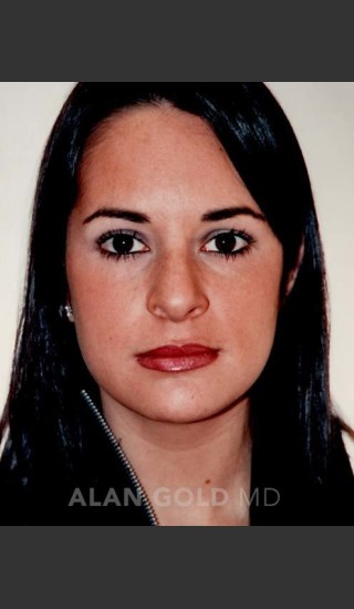 Before Photo for Rhinoplasty 194 - Alan Gold MD - Prejuvenation