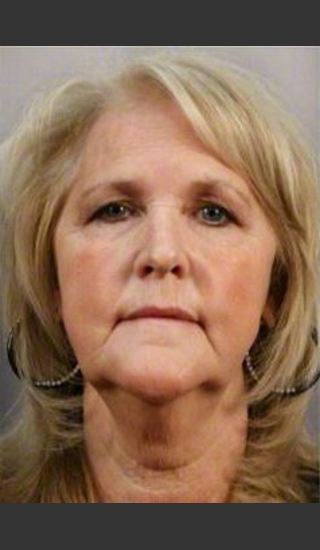 Before Photo for 58 Year Old Female: Facelift - R. Scott Yarish MD, FACS - Prejuvenation