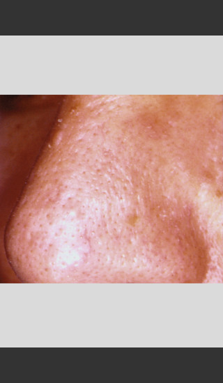 After Photo for Vbeam Laser Treatment of Nose Veins -  - Prejuvenation