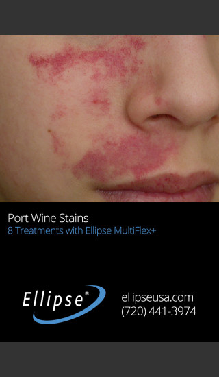 Before Photo for Treatment of Port Wine Stain on the Face -  - Prejuvenation