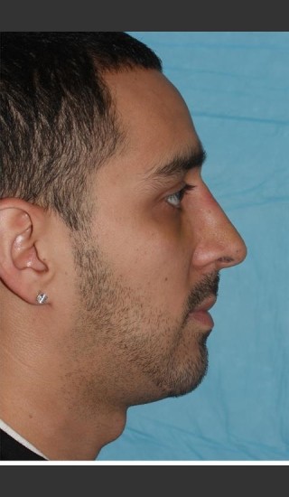 After Photo for Rhinoplasty - Case 17 - Konstantin Vasyukevich, MD - Prejuvenation