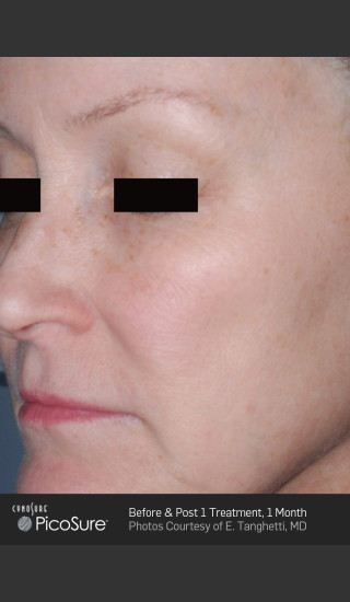 After Photo for Full Face Wrinkle Treatment With PicoSure -  - Prejuvenation