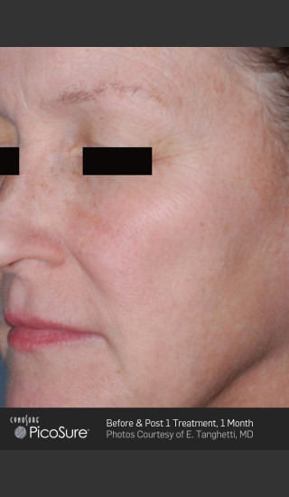 Before Photo for Full Face Wrinkle Treatment With PicoSure -  - Prejuvenation