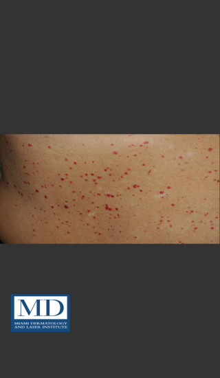 Before Photo for Angioma Treatment 106 - Jill S. Waibel, MD - Prejuvenation