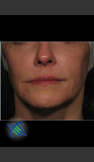 Before Photo for Facial Laxity of Lower Face with Profound - Roy G. Geronemus, M.D. - Prejuvenation