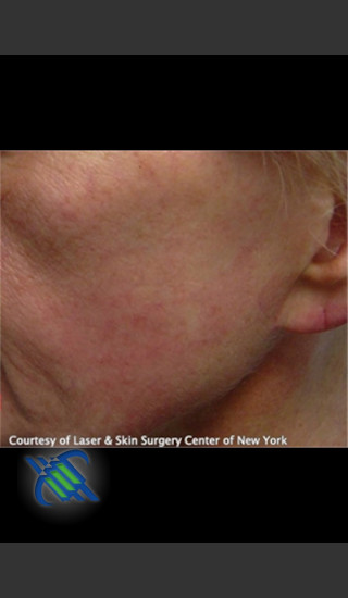 After Photo for Treatment of Facial Blood Vessels - Roy G. Geronemus, M.D. - Prejuvenation