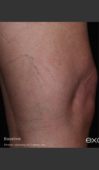 Before Photo for Leg Vein Clearance Using Excel V -  - Prejuvenation