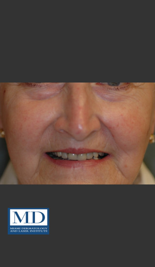 After Photo for Rosacea Treatment 101 - Jill S. Waibel, MD - Prejuvenation