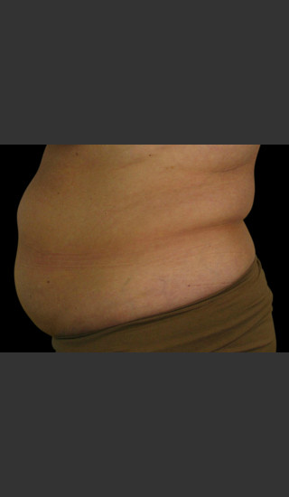 Before Photo for Body Contouring Treatment #121 -  - Prejuvenation