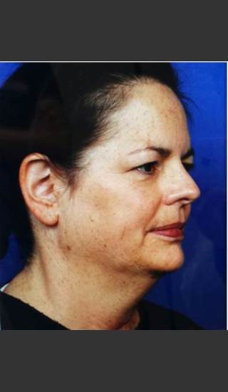 Before Photo for Infini Rhytides Treatment -  - Prejuvenation