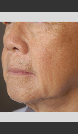 After Photo for elos Motif IR for Focused Wrinkle Treatment -  - Prejuvenation