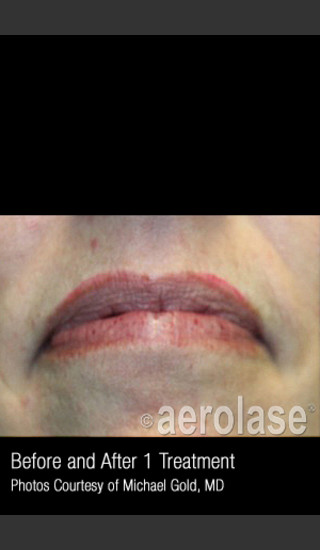 After Photo for Treatment of Facial Blood Vessels #337 -  - Prejuvenation