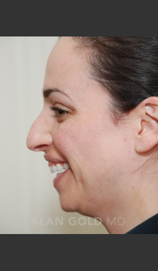 Before Photo for Rhinoplasty 1683 Side View - Alan Gold MD - Prejuvenation