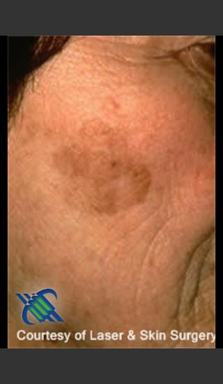 Before Photo for Treatment of Brown Spot on Cheek - Roy G. Geronemus, M.D. - Prejuvenation