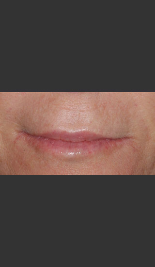 After Photo for Treatment of Perioral Wrinkles - Roy G. Geronemus, M.D. - Prejuvenation