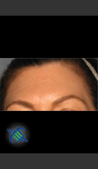 After Photo for Laser Treatment of Forehead Wrinkles - Roy G. Geronemus, M.D. - Prejuvenation