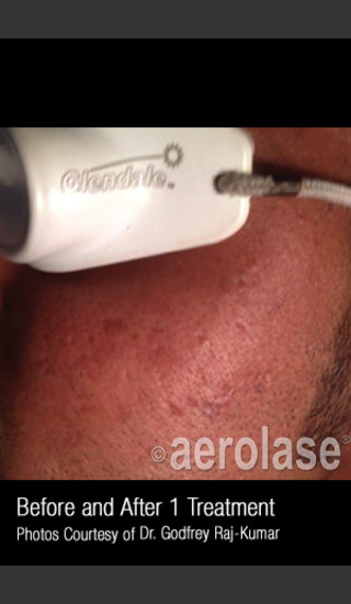 After Photo for #306 - Treatment of Acne Scars -  - Prejuvenation