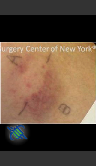 After Photo for Treatment of Brusing with Pulsed Dye Laser - Roy G. Geronemus, M.D. - Prejuvenation