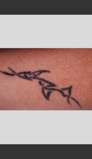 Before Photo for PicoWay Tattoo Removal of Barb Wire -  - Prejuvenation