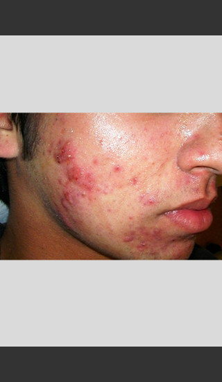 Before Photo for elos Technology AC for Acne Treatment -  - Prejuvenation