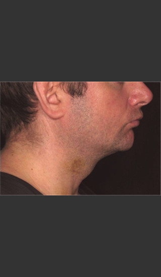 After Photo for Treatment of Neck Contour -  - Prejuvenation