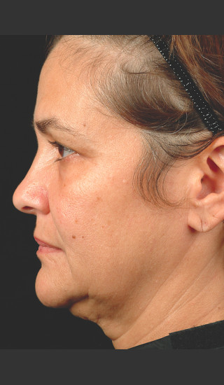 Before Photo for Thermage Procedure Before and After II -  - Prejuvenation