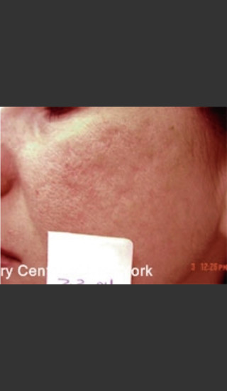 After Photo for Treatment of Facial  Acne Scarring -  - Prejuvenation