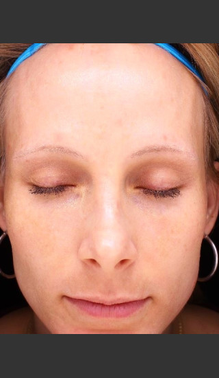 After Photo for Photoaging and Melasma  - Paul M. Friedman, M.D. - Prejuvenation