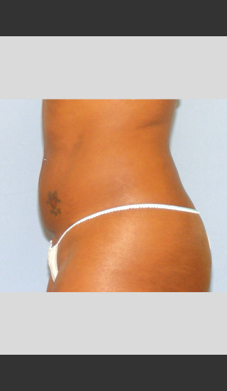 After Photo for UltraShape Focused Ultrasound Female Abdomen -  - Prejuvenation