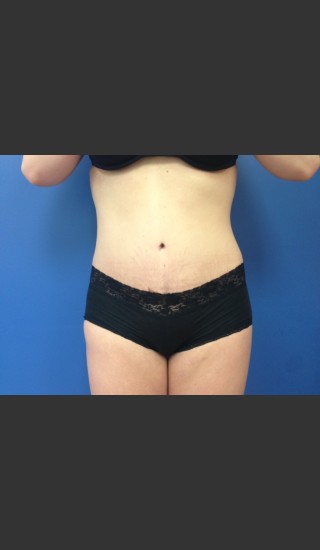 After Photo for Abdominoplasty (Tummy Tuck) Before & After - Dr. Josh Olson - Prejuvenation