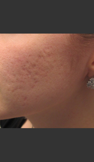 Before Photo for Infini Acne Scar Treatment #11 -  - Prejuvenation