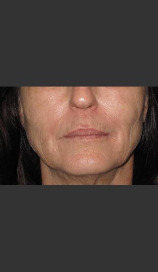 Before Photo for Infini Rhytides Treatment #15 -  - Prejuvenation