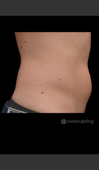 Before Photo for CoolSculpting Before & After on Man -  - Prejuvenation