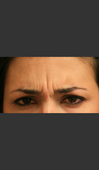 Before Photo for Botox for Glabellar Lines - James Newman - Prejuvenation