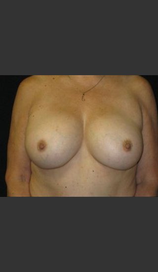 After Photo for Breast Augmentation  - Robert Aycock - Prejuvenation