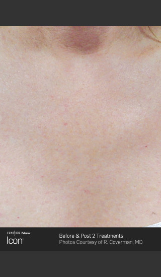 After Photo for Skin Revitalization of Chest Using Icon -  - Prejuvenation