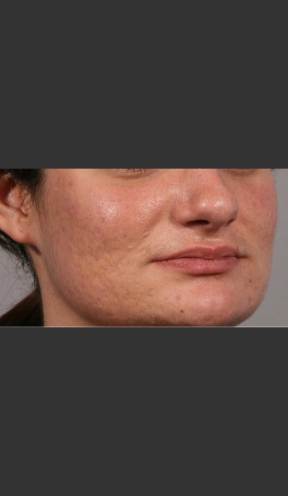 After Photo for 3DEEP Intensif Microneedling #2 -  - Prejuvenation