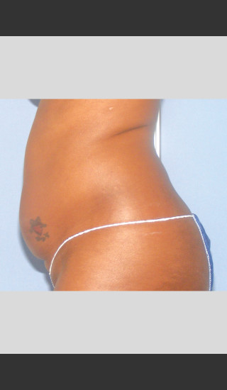 Before Photo for UltraShape Focused Ultrasound Female Abdomen -  - Prejuvenation