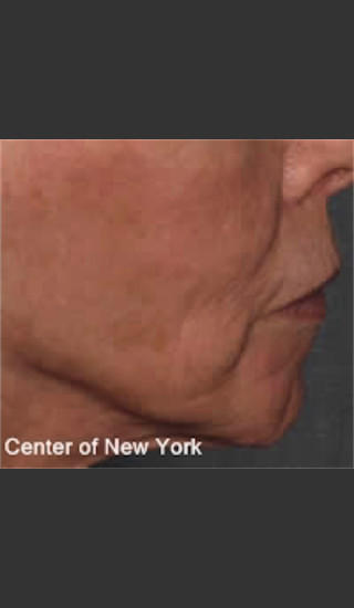 After Photo for Treatment of Fine lines and Wrinkles -  - Prejuvenation