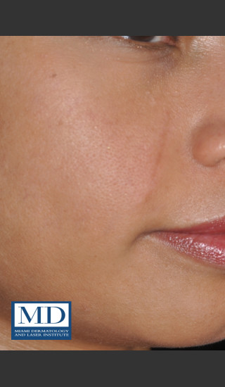 After Photo for Melasma Face Treatment 116 - Jill S. Waibel, MD - Prejuvenation