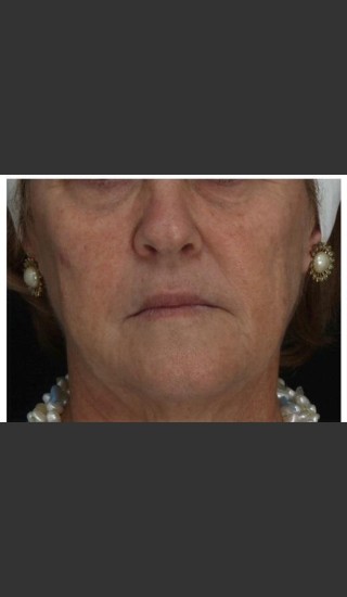 Before Photo for Immediate Lifting of Corners of the Mouth after Juvederm Ultra injection (effect is immediately after injection) - Leyda Elizabeth Bowes, M.D. - Prejuvenation