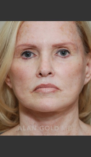 After Photo for Rhytidectomy (Facelift) 1753 - Alan Gold MD - Prejuvenation