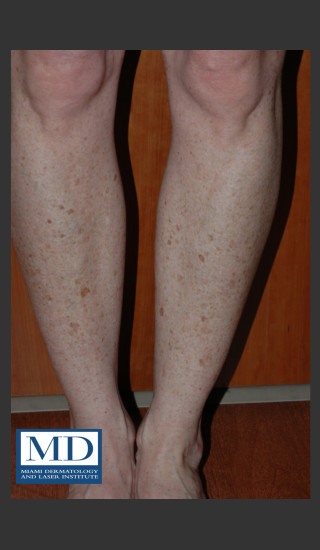 Before Photo for Photorejuvenation Treatment 111 - Jill S. Waibel, MD - Prejuvenation