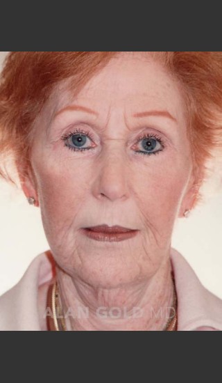 Before Photo for Rhytidectomy (Facelift) 161 - Alan Gold MD - Prejuvenation